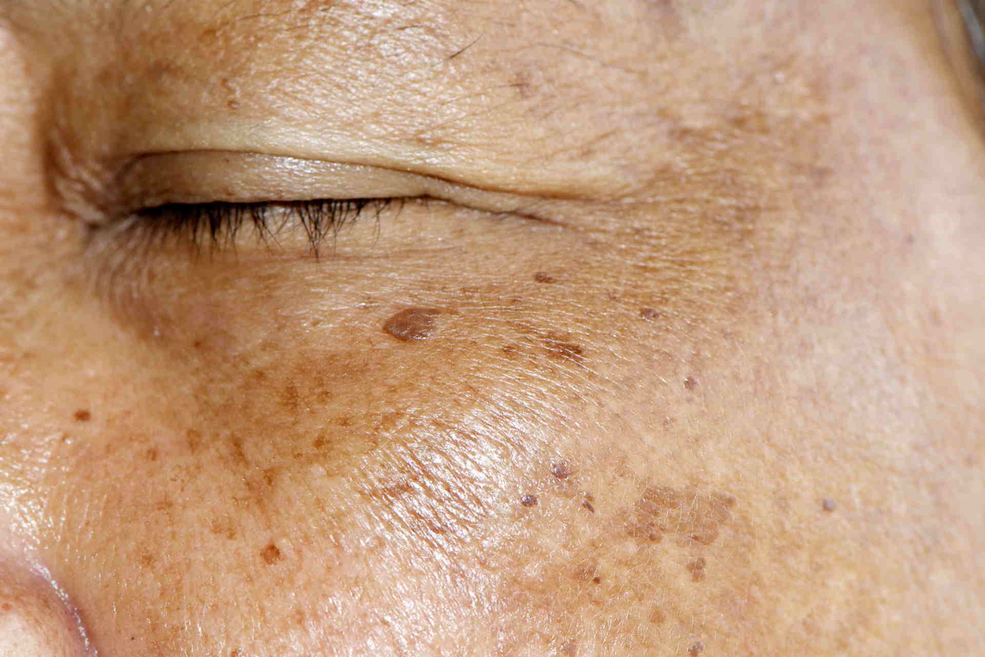 Macchie della pelle e del viso dopo i 40 anni: perché vengono?